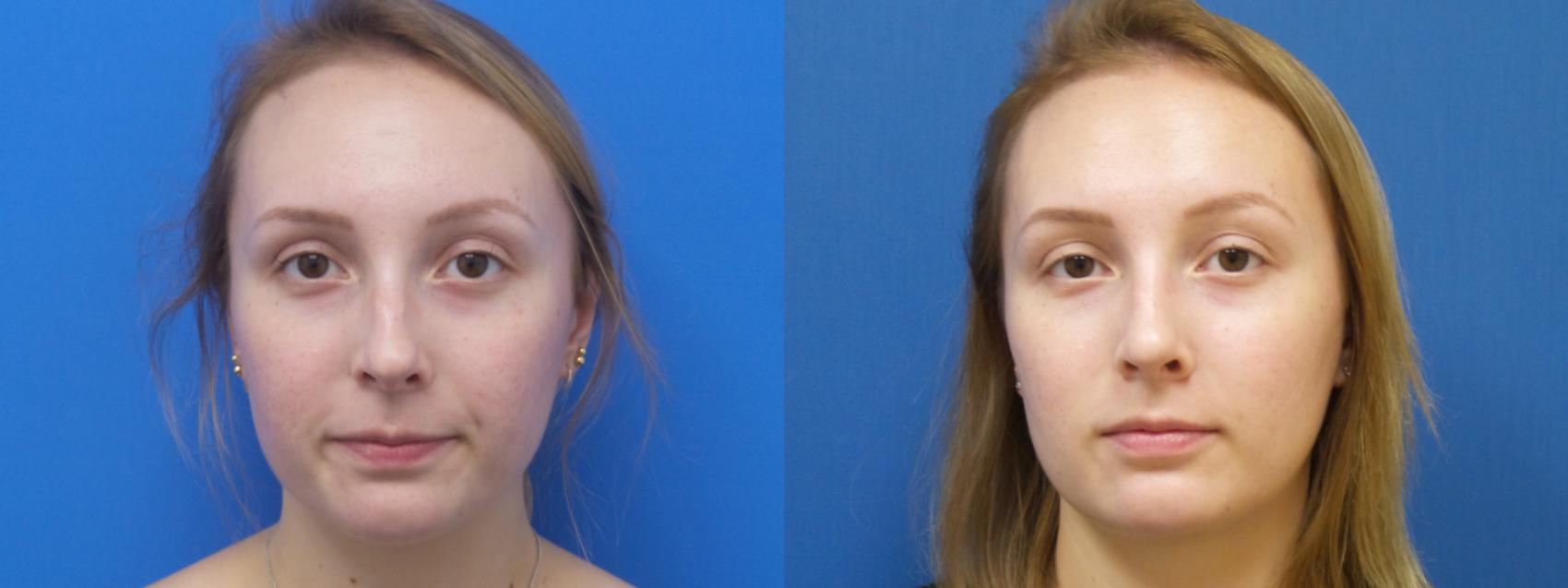 Rhinoplasty Case 296 Before & After Front | Webster, TX | Houston Plastic and Reconstructive Surgery