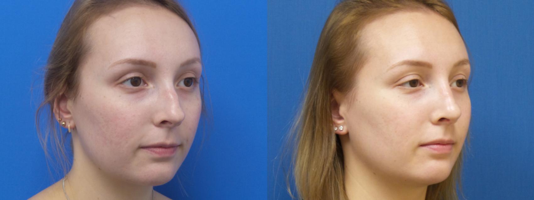 Rhinoplasty Before & After Photos Patient 296 ster, TX Houston