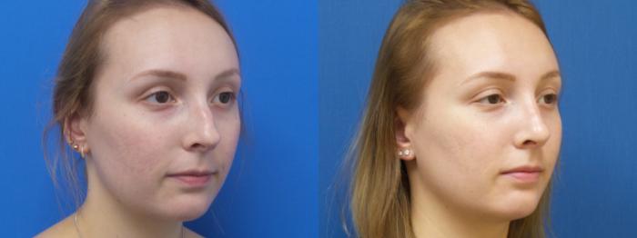 Rhinoplasty Case 296 Before & After Right Oblique | Webster, TX | Houston Plastic and Reconstructive Surgery