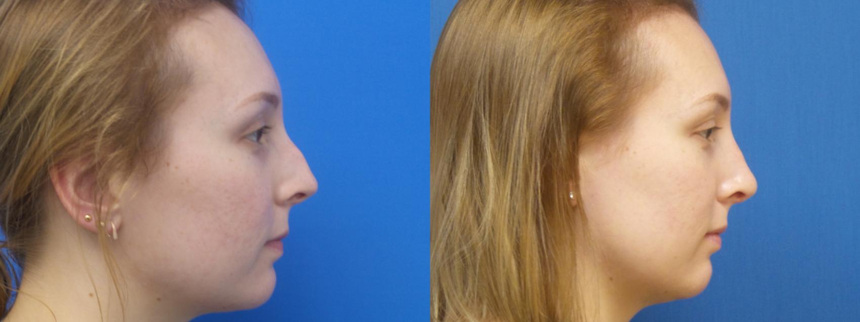 Rhinoplasty Before & After Photos Patient 296 ster, TX Houston