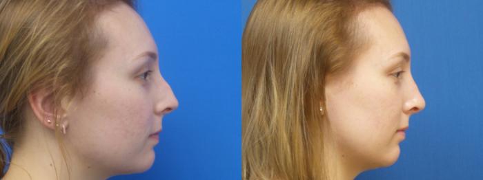 Rhinoplasty Case 296 Before & After Right Side | Webster, TX | Houston Plastic and Reconstructive Surgery