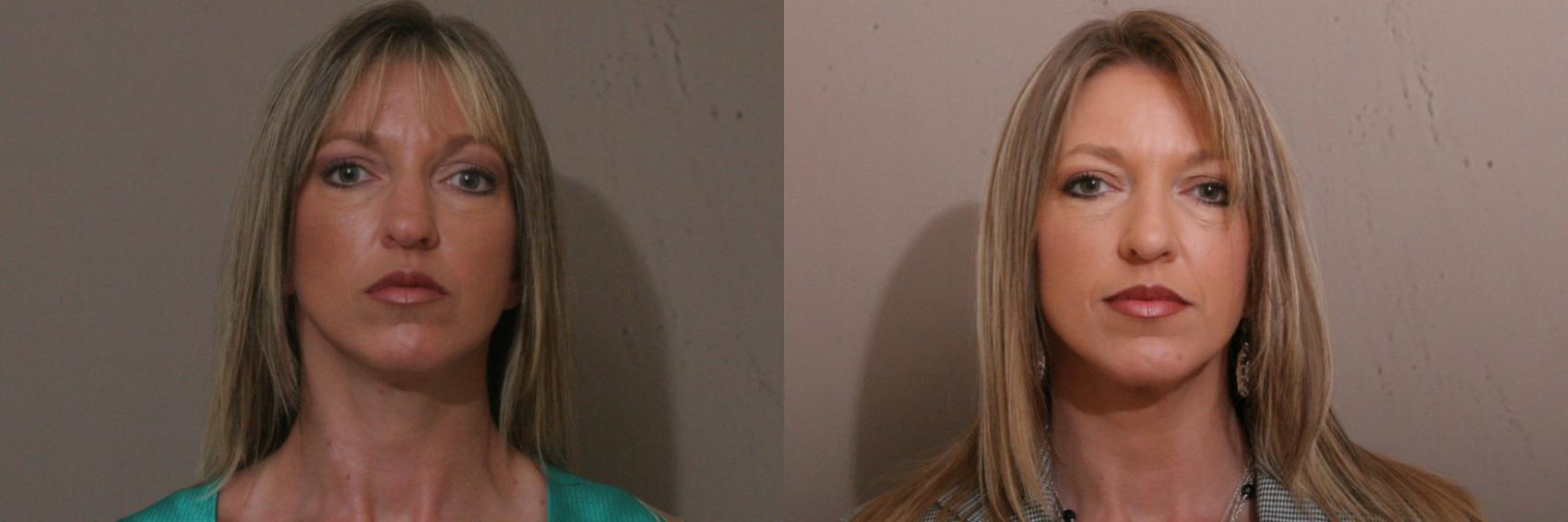 Rhinoplasty Case 74 Before & After View #1 | Webster, TX | Houston Plastic and Reconstructive Surgery