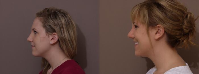 Rhinoplasty Case 93 Before & After View #2 | Webster, TX | Houston Plastic and Reconstructive Surgery