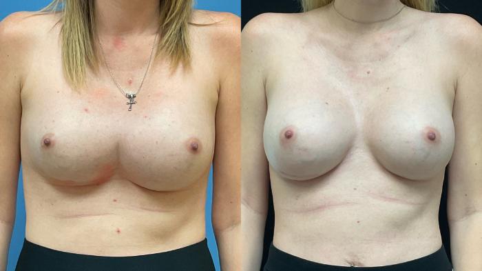 Breast Implant Exchange Case 308 Before & After Front | Webster, TX | Houston Plastic and Reconstructive Surgery