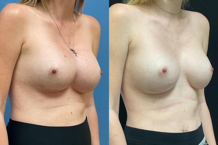 Symmastia Repair Case 308 Before & After Right Oblique | Webster, TX | Houston Plastic and Reconstructive Surgery