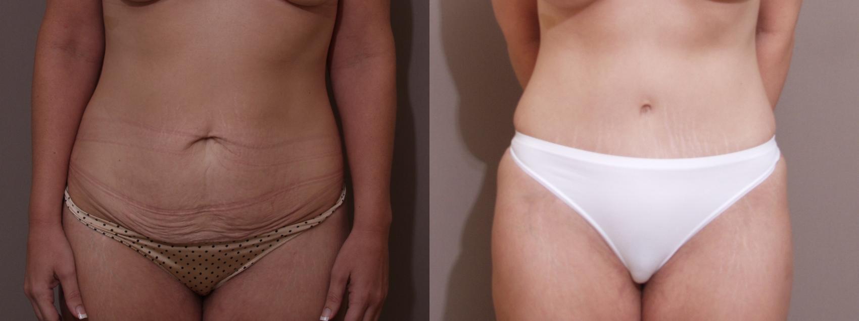 Tummy Tuck Case 100 Before & After View #1 | Webster, TX | Houston Plastic and Reconstructive Surgery