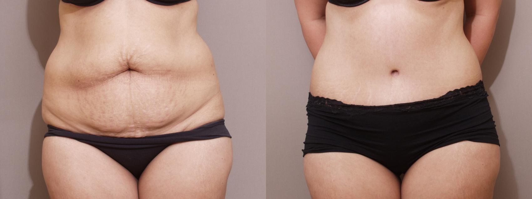 Tummy Tuck Case 102 Before & After View #1 | Webster, TX | Houston Plastic and Reconstructive Surgery