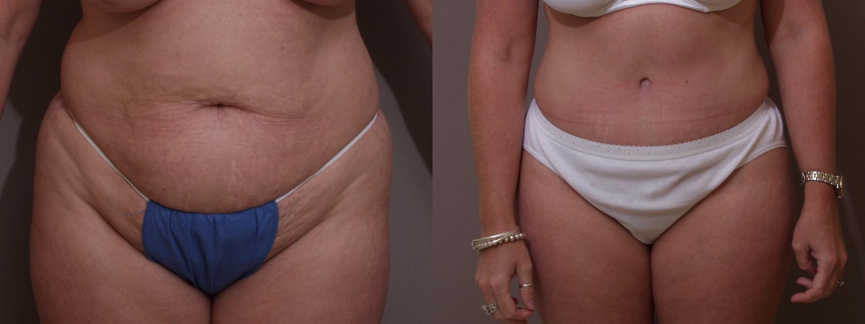 Tummy Tuck Case 106 Before & After View #1 | Webster, TX | Houston Plastic and Reconstructive Surgery