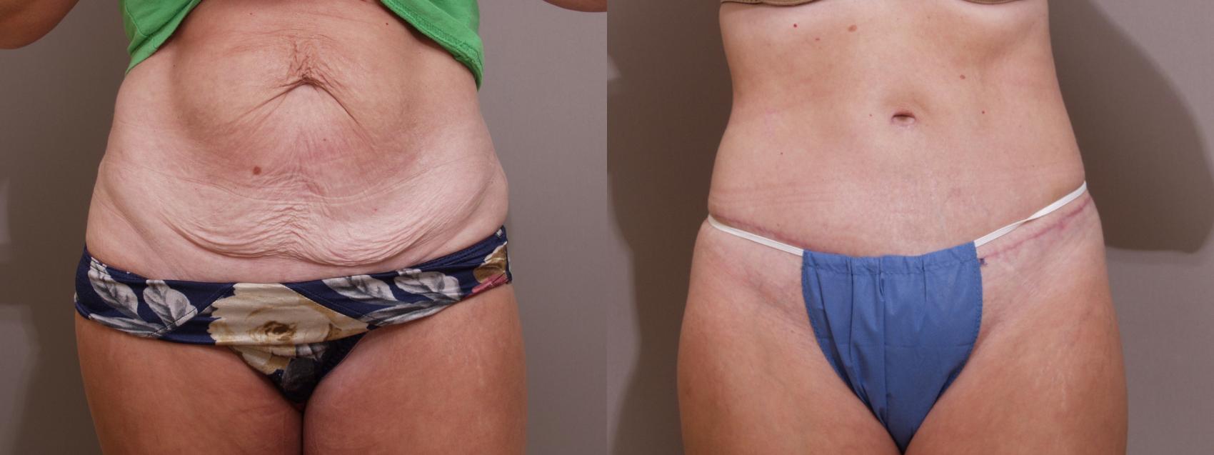 Tummy Tuck Case 115 Before & After View #1 | Webster, TX | Houston Plastic and Reconstructive Surgery
