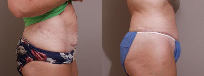 Tummy Tuck Case 115 Before & After View #2 | Webster, TX | Houston Plastic and Reconstructive Surgery