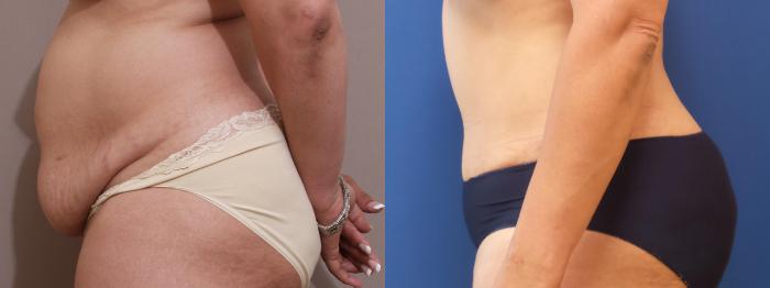 Tummy Tuck Case 161 Before & After View #2 | Webster, TX | Houston Plastic and Reconstructive Surgery