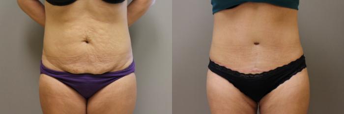 Tummy Tuck Case 162 Before & After View #1 | Webster, TX | Houston Plastic and Reconstructive Surgery