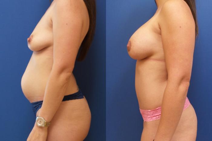 Tummy Tuck Case 170 Before & After View #1 | Webster, TX | Houston Plastic and Reconstructive Surgery