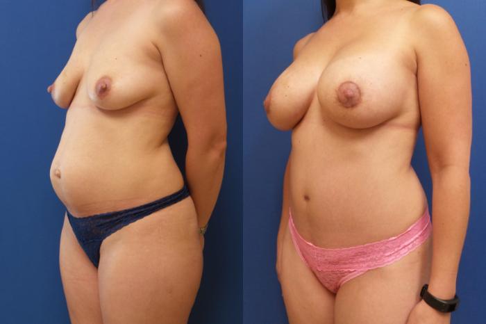 Tummy Tuck Case 170 Before & After View #2 | Webster, TX | Houston Plastic and Reconstructive Surgery