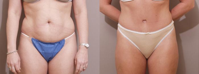 Tummy Tuck (Abdominoplasty) in Houston, TX