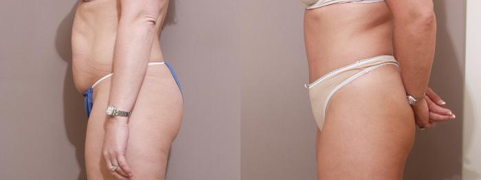 Tummy Tuck Before and After Pictures Case 364, Houston, TX