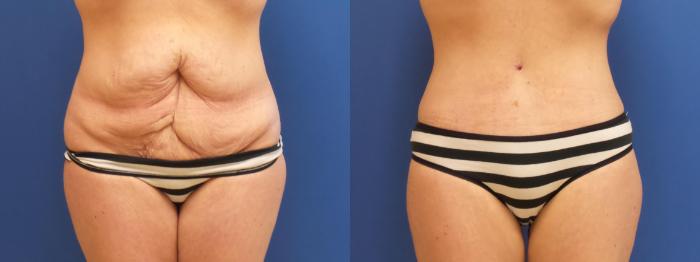 Tummy Tuck Case 227 Before & After View #1 | Webster, TX | Houston Plastic and Reconstructive Surgery