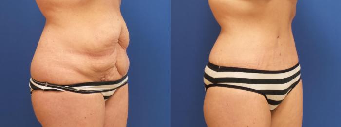 Tummy Tuck Case 227 Before & After View #2 | Webster, TX | Houston Plastic and Reconstructive Surgery