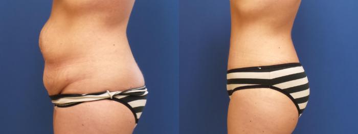 Tummy Tuck Case 227 Before & After View #3 | Webster, TX | Houston Plastic and Reconstructive Surgery