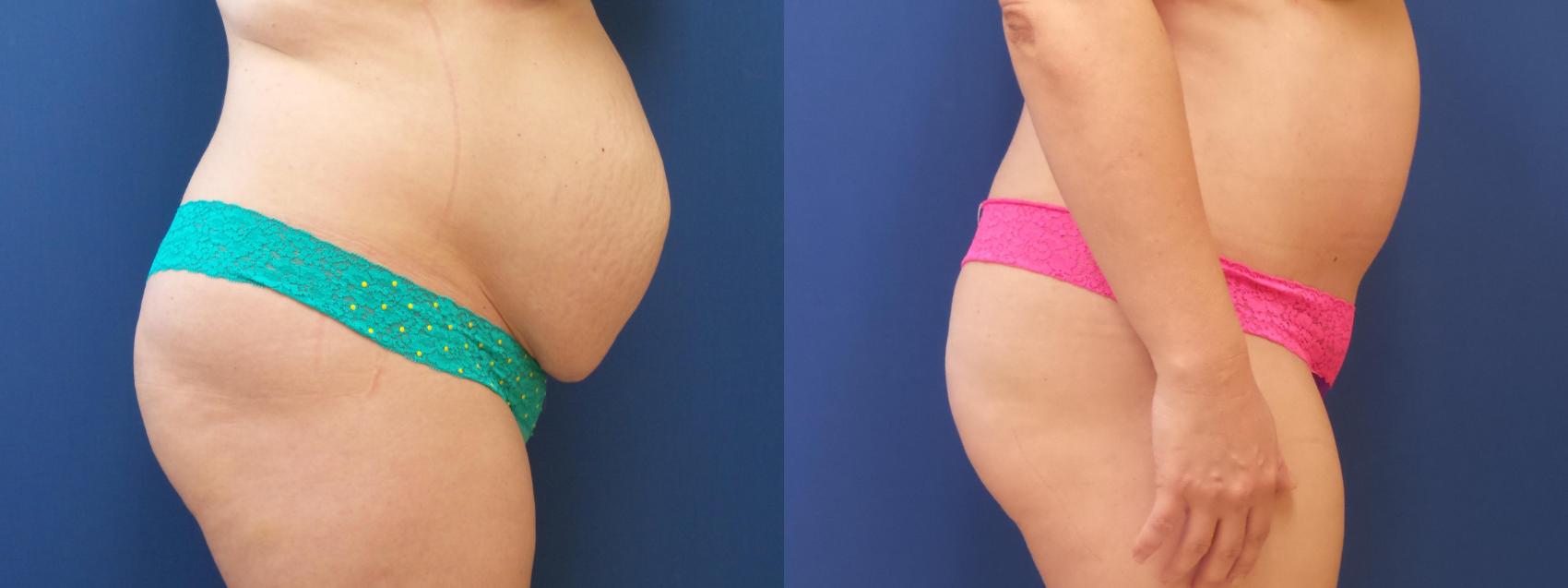 Tummy Tuck Case 228 Before & After View #1 | Webster, TX | Houston Plastic and Reconstructive Surgery