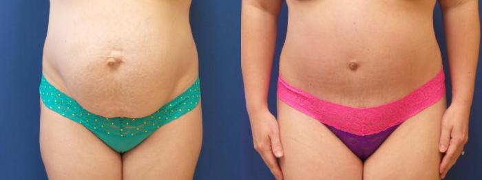 Tummy Tuck Case 228 Before & After View #2 | Webster, TX | Houston Plastic and Reconstructive Surgery