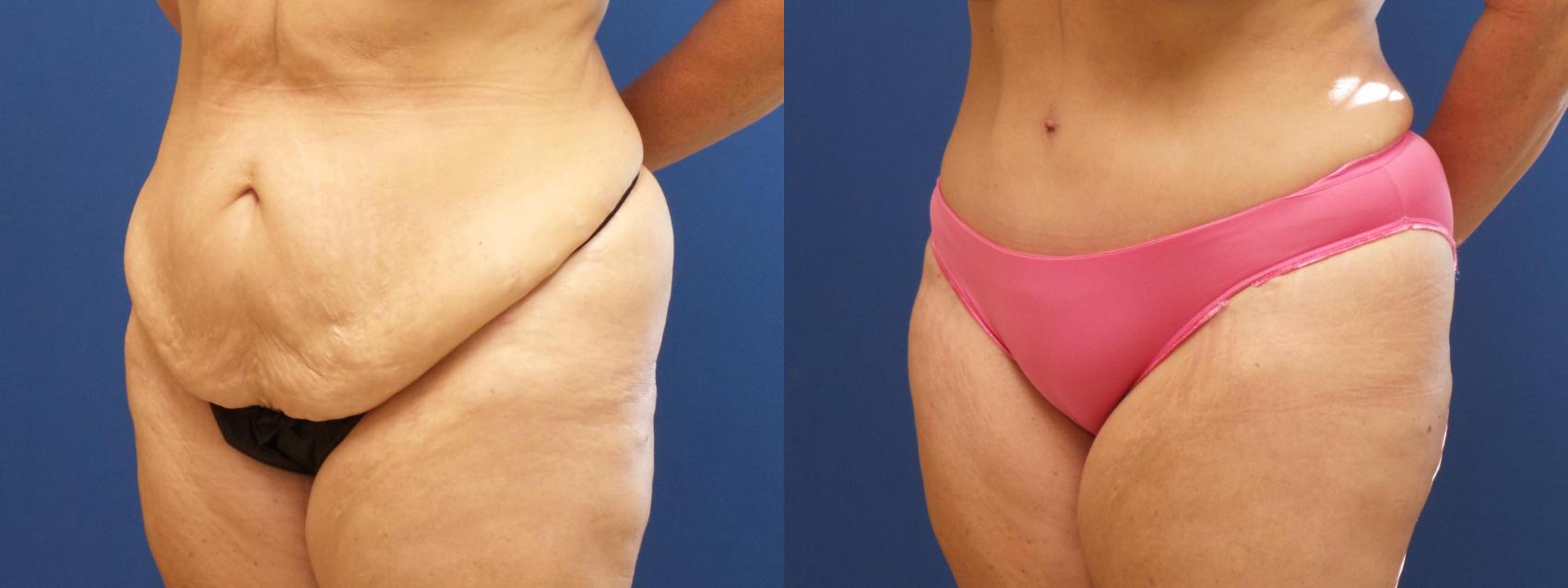 Tummy Tuck Case 229 Before & After View #1 | Webster, TX | Houston Plastic and Reconstructive Surgery