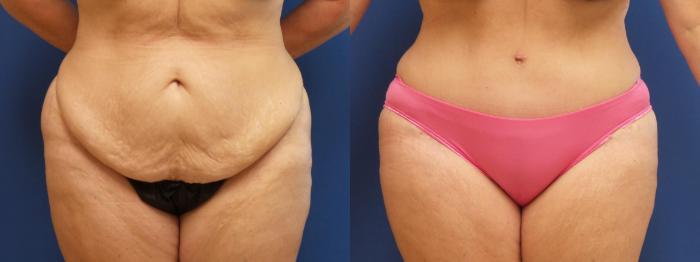 Tummy Tuck Case 229 Before & After View #2 | Webster, TX | Houston Plastic and Reconstructive Surgery