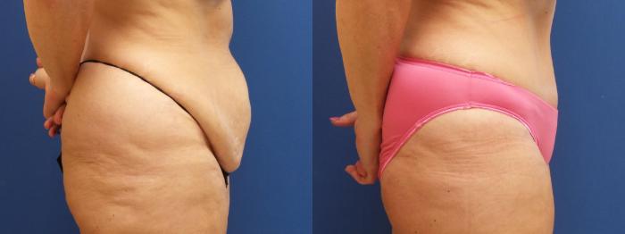 Tummy Tuck Case 229 Before & After View #3 | Webster, TX | Houston Plastic and Reconstructive Surgery