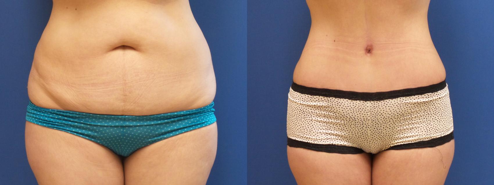 Tummy Tuck Case 230 Before & After View #1 | Webster, TX | Houston Plastic and Reconstructive Surgery