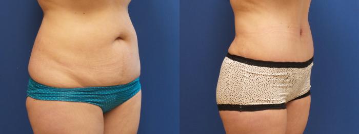 Tummy Tuck Case 230 Before & After View #2 | Webster, TX | Houston Plastic and Reconstructive Surgery