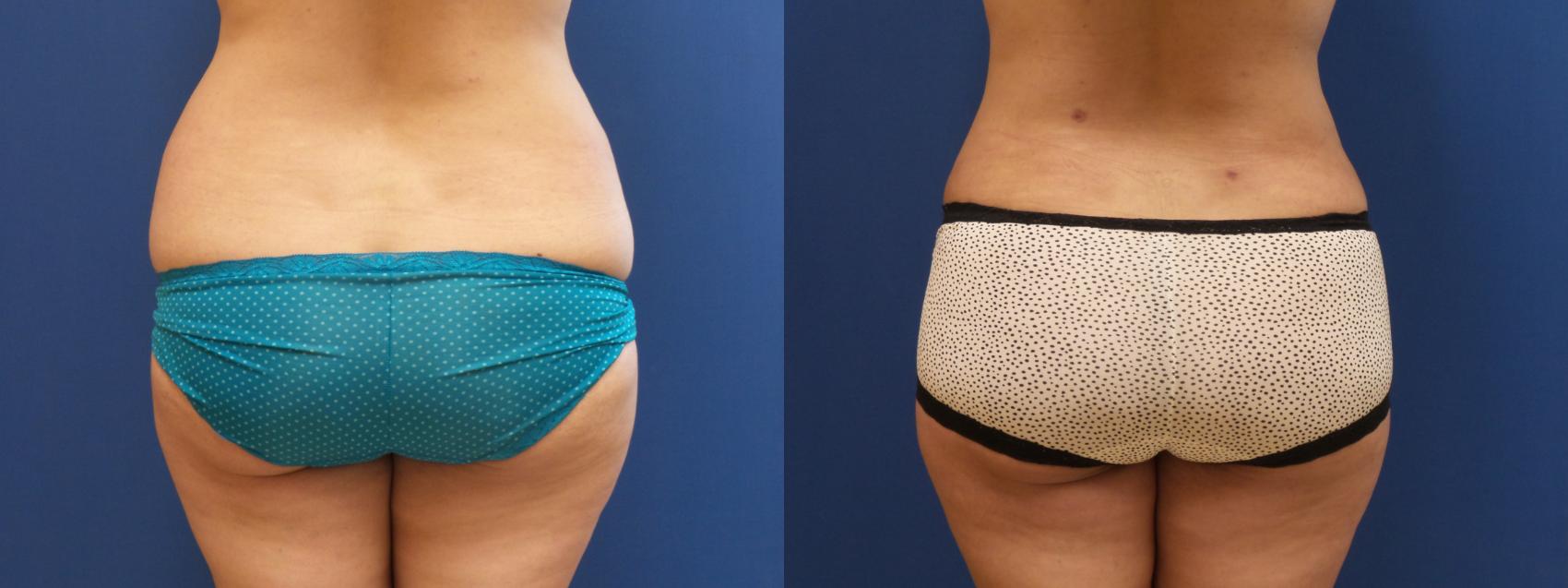 Tummy Tuck Case 230 Before & After View #3 | Webster, TX | Houston Plastic and Reconstructive Surgery