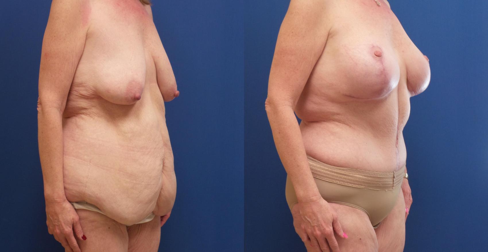 Tummy Tuck Case 231 Before & After View #1 | Webster, TX | Houston Plastic and Reconstructive Surgery
