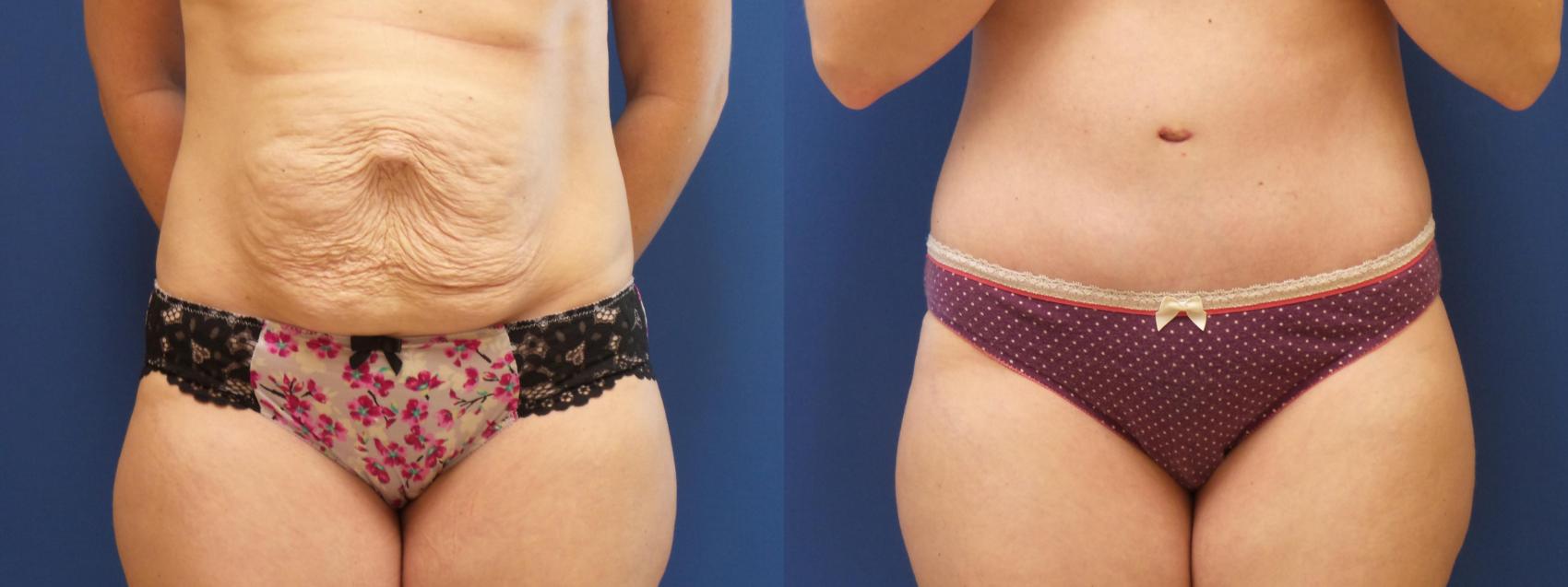 Tummy Tuck Case 254 Before & After View #1 | Webster, TX | Houston Plastic and Reconstructive Surgery