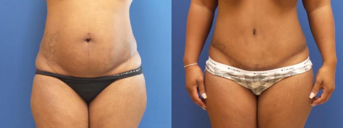 Tummy Tuck Case 282 Before & After View #1 | Webster, TX | Houston Plastic and Reconstructive Surgery