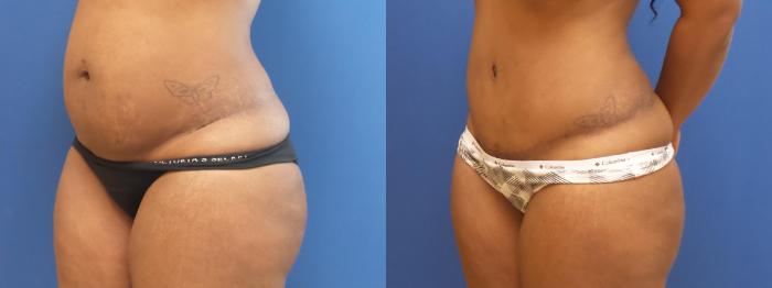 Tummy Tuck Case 282 Before & After View #2 | Webster, TX | Houston Plastic and Reconstructive Surgery