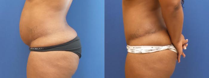 Tummy Tuck Case 282 Before & After View #3 | Webster, TX | Houston Plastic and Reconstructive Surgery