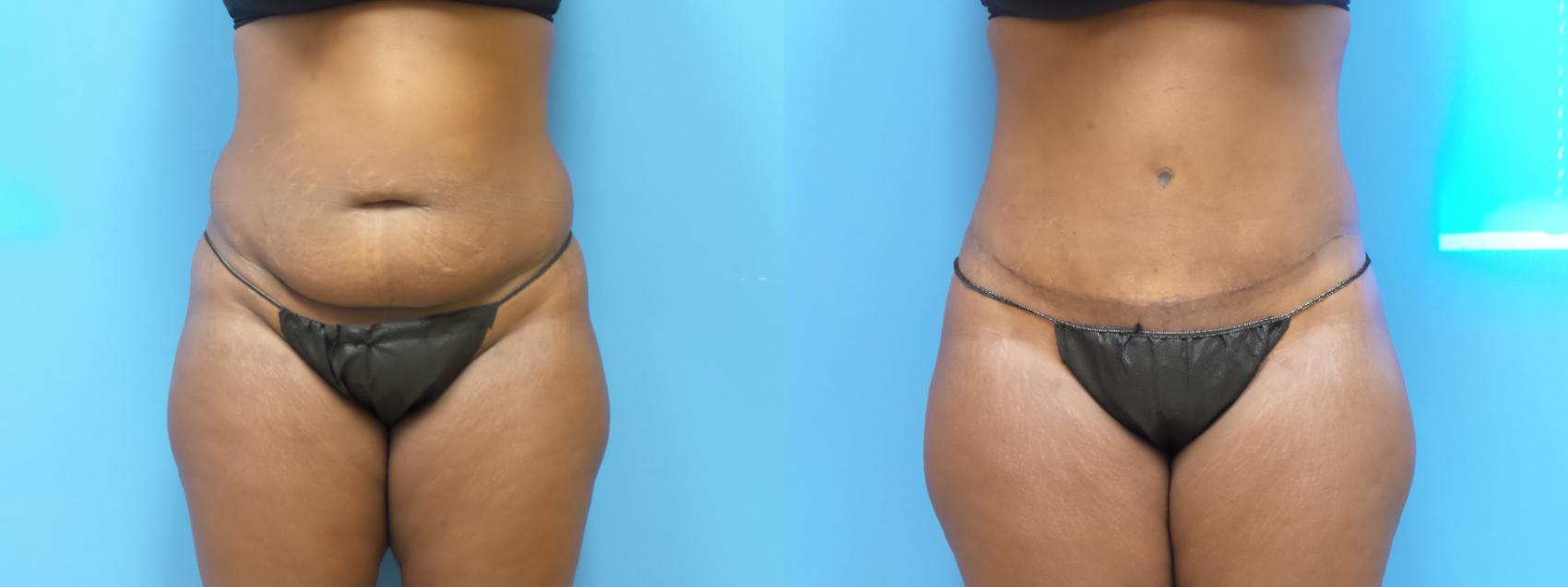 Tummy Tuck Case 292 Before & After Front | Webster, TX | Houston Plastic and Reconstructive Surgery