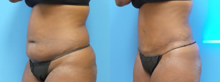 Liposuction Case 292 Before & After Left Oblique | Webster, TX | Houston Plastic and Reconstructive Surgery