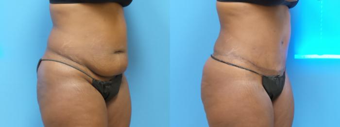 Liposuction Case 292 Before & After Right Oblique | Webster, TX | Houston Plastic and Reconstructive Surgery