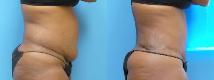 Liposuction Case 292 Before & After Right Side | Webster, TX | Houston Plastic and Reconstructive Surgery
