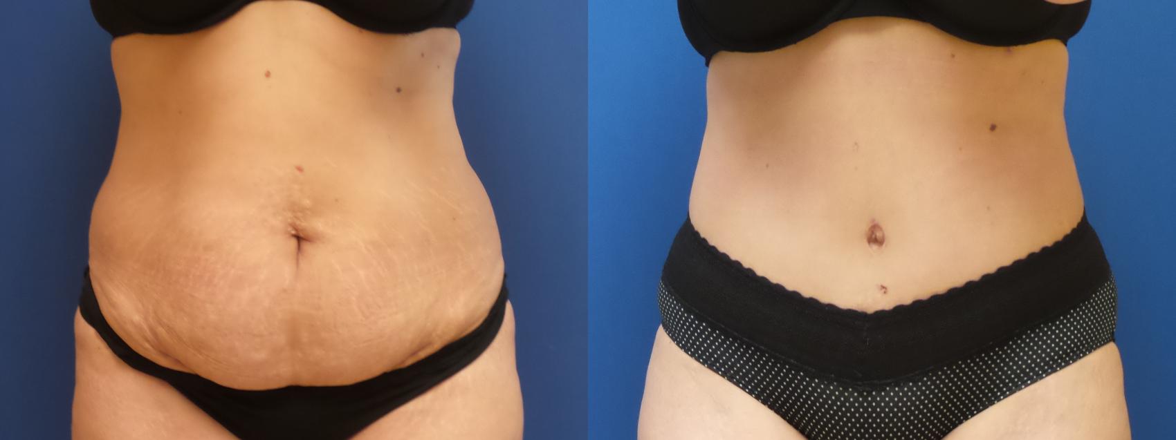 Tummy Tuck Case 295 Before & After Front | Webster, TX | Houston Plastic and Reconstructive Surgery