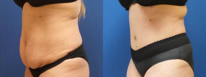 Tummy Tuck Case 295 Before & After Left Oblique | Webster, TX | Houston Plastic and Reconstructive Surgery