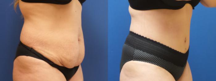 Tummy Tuck Case 295 Before & After Right Oblique | Webster, TX | Houston Plastic and Reconstructive Surgery