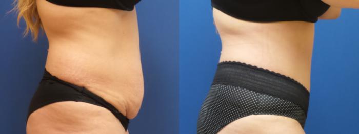 Tummy Tuck Case 295 Before & After Right Side | Webster, TX | Houston Plastic and Reconstructive Surgery