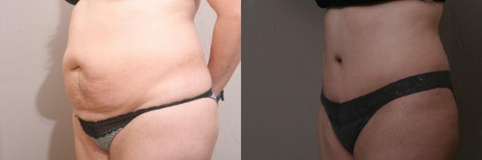 Tummy Tuck Case 53 Before & After View #1 | Webster, TX | Houston Plastic and Reconstructive Surgery