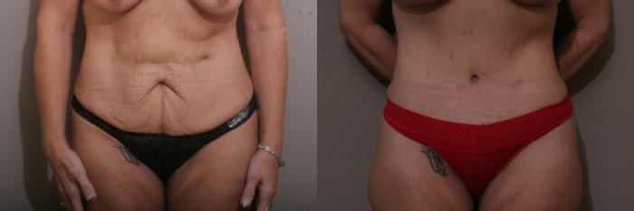 Tummy Tuck Case 57 Before & After View #1 | Webster, TX | Houston Plastic and Reconstructive Surgery