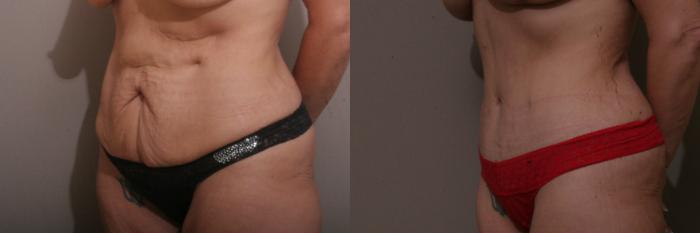 Tummy Tuck Case 57 Before & After View #2 | Webster, TX | Houston Plastic and Reconstructive Surgery