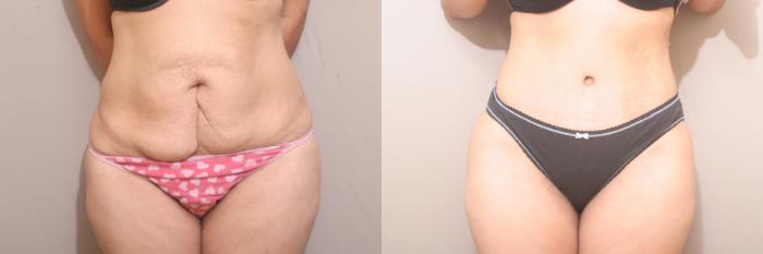 Tummy Tuck Case 58 Before & After View #1 | Webster, TX | Houston Plastic and Reconstructive Surgery