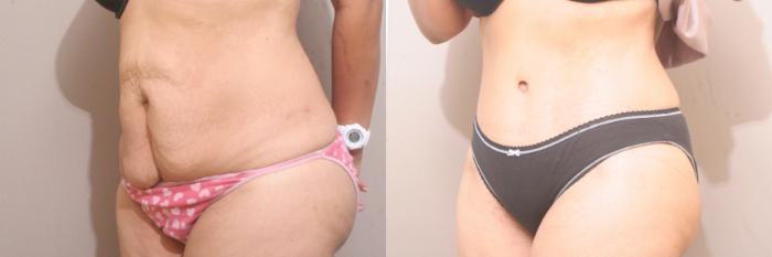 Tummy Tuck Case 58 Before & After View #2 | Webster, TX | Houston Plastic and Reconstructive Surgery