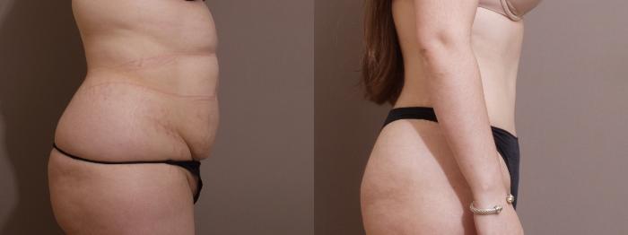 Tummy Tuck Case 63 Before & After View #2 | Webster, TX | Houston Plastic and Reconstructive Surgery